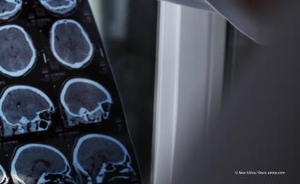 Un médecin examine les images IRM d'un patient atteint de sclérose en plaques, maladie auto-immune et neurodégénérative qui touche le cerveau et la moelle épinière.